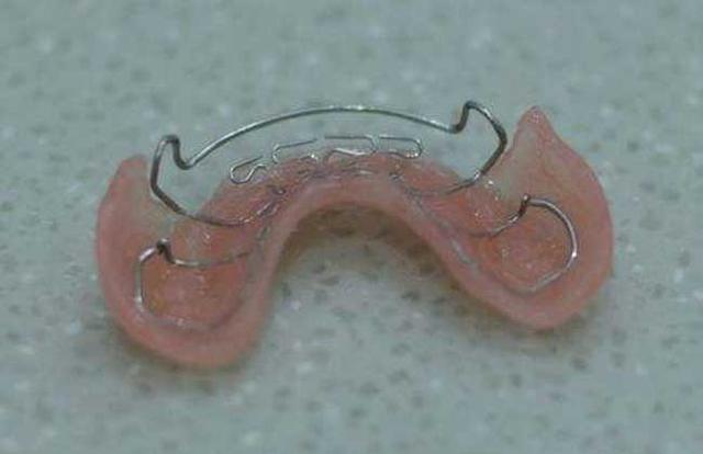 牙套价格多少钱一个 牙套有哪些种类