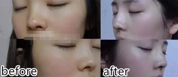 玻尿酸+埋线隆鼻 不开刀也能挺起鼻尖|名医专访