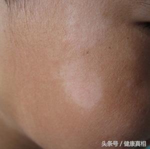 孩子脸上肤色不均?有白白的一块,你以为是白癜风,别大惊小怪,其实是这个病