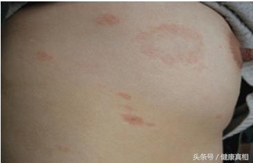 孩子脸上肤色不均?有白白的一块,你以为是白癜风,别大惊小怪,其实是这个病