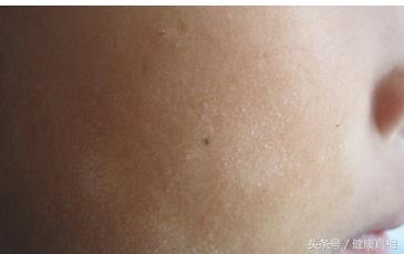 孩子脸上肤色不均?有白白的一块,你以为是白癜风,别大惊小怪,其实是这个病