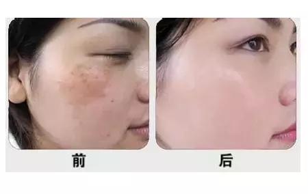 和光子嫩肤有关的核心问题,看这篇就够了!