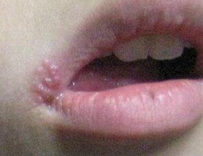嘴角起泡是什么原因?如何快速恢复?