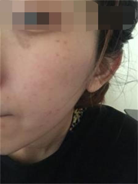 眼睛下面长斑的原因 你知道多少呢?