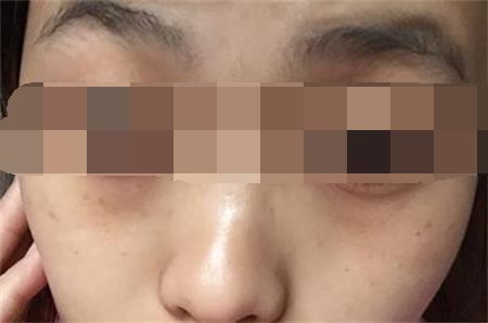 眼睛下面长斑的原因 你知道多少呢?