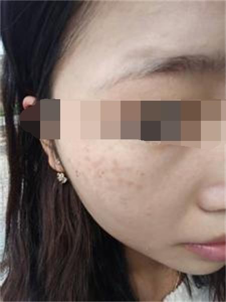 眼睛下面长斑的原因 你知道多少呢?