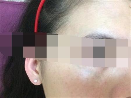 眼睛下面长斑的原因 你知道多少呢?