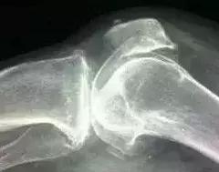治疗骨刺,这五个方法最有效!