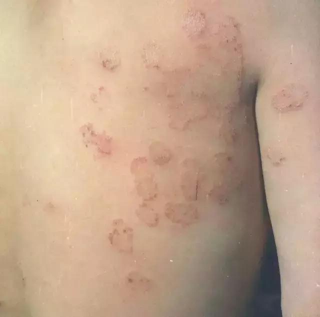 小难点:如何区分癣与其它皮肤疾病