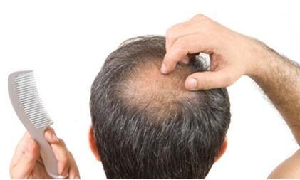治疗脱发和秃顶的几个小方法，给大家参考！