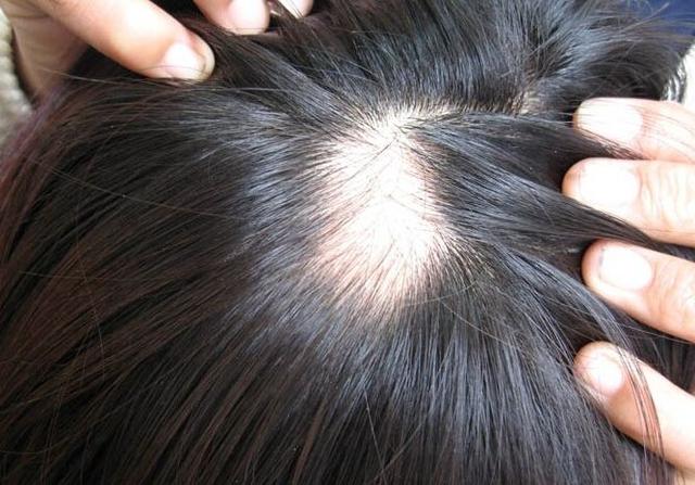 治疗脱发和秃顶的几个小方法，给大家参考！
