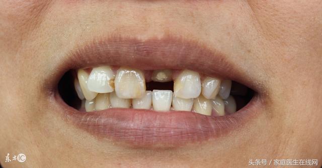 牙磕断了一半怎么办？牙缺损要如何修复？