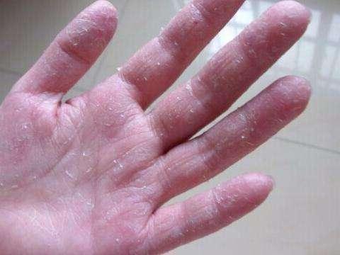 手掌、手指蜕皮严重，是天气干燥还是手癣？五大偏方帮助你不复发