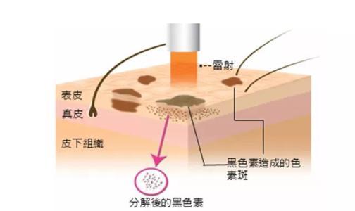 如何让红色痘印、黑色痘印消失地快点｜三大要点请记住