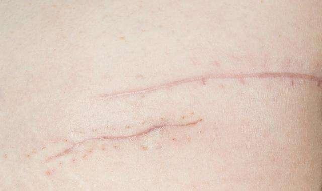 路医生说丨手术之后疤痕明显，有什么药物能有效消除或预防疤痕？